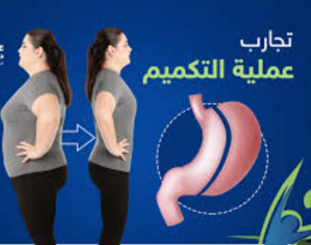 تكميم المعدة: طريقة فعالة لفقدان الوزن وتحسين نوعية الحياة. Do